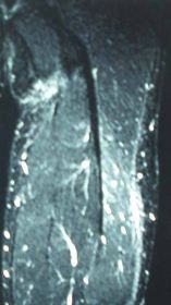 大腿ハムストリング腱断裂 術後4ヶ月