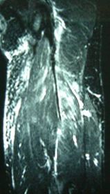 大腿ハムストリング腱断裂 術後4週間